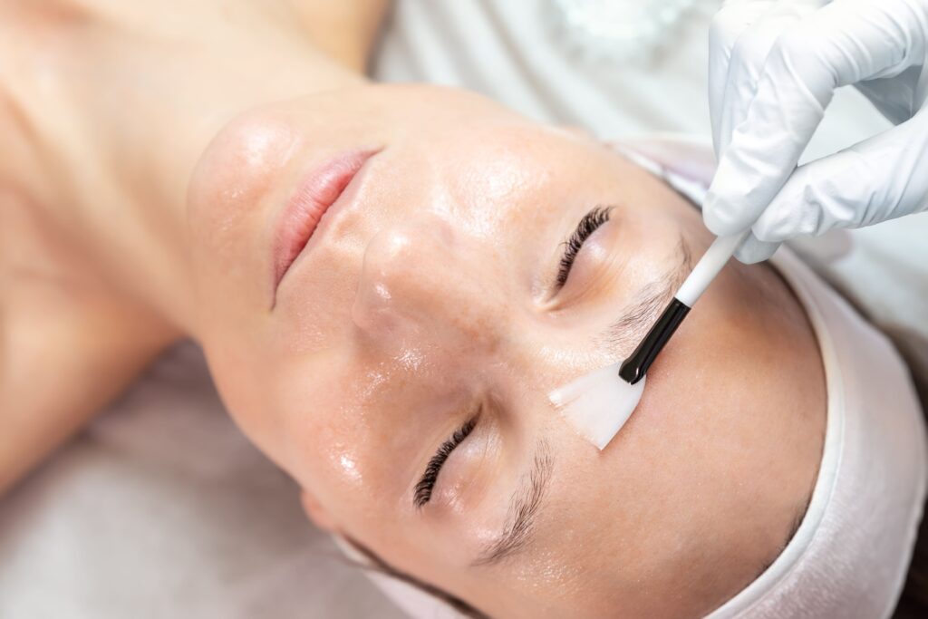 foto-peeling-quimico-tratamientos-faciales-estética-colina